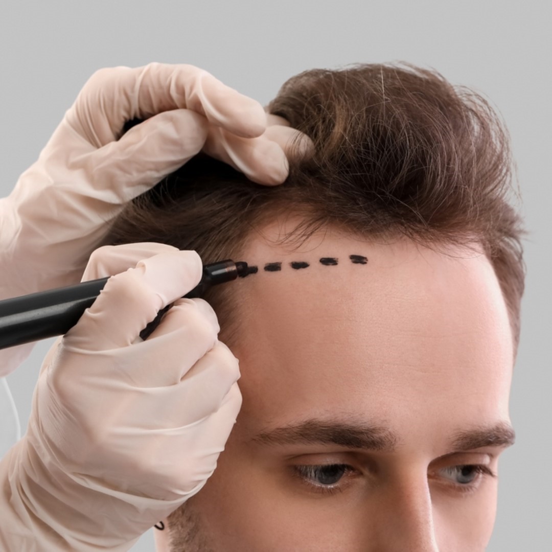 Hair transplantation