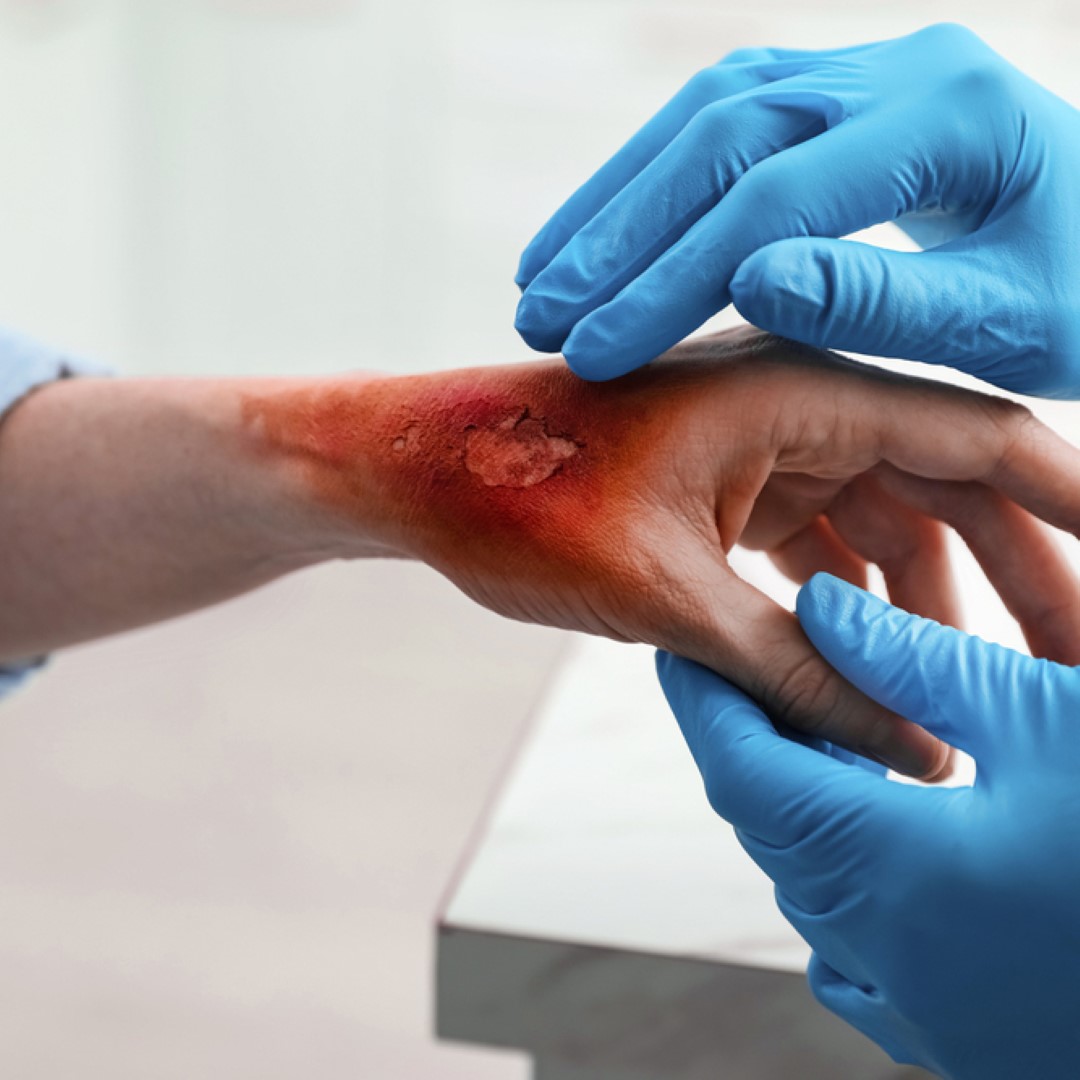 Post Burn Contractures