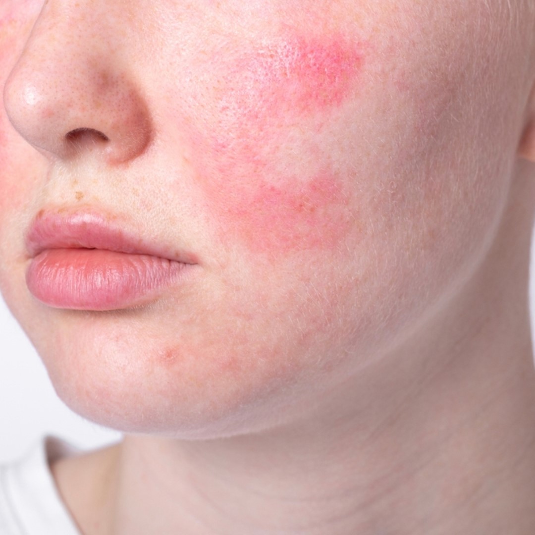 Soft Tissue Reconstruction