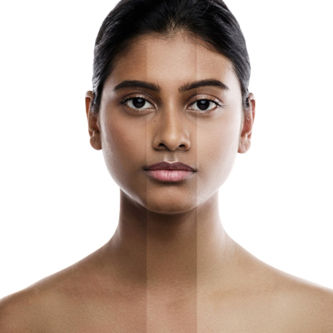 skin Lightening Treatment